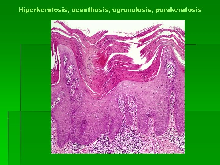 Hiperkeratosis, acanthosis, agranulosis, parakeratosis 