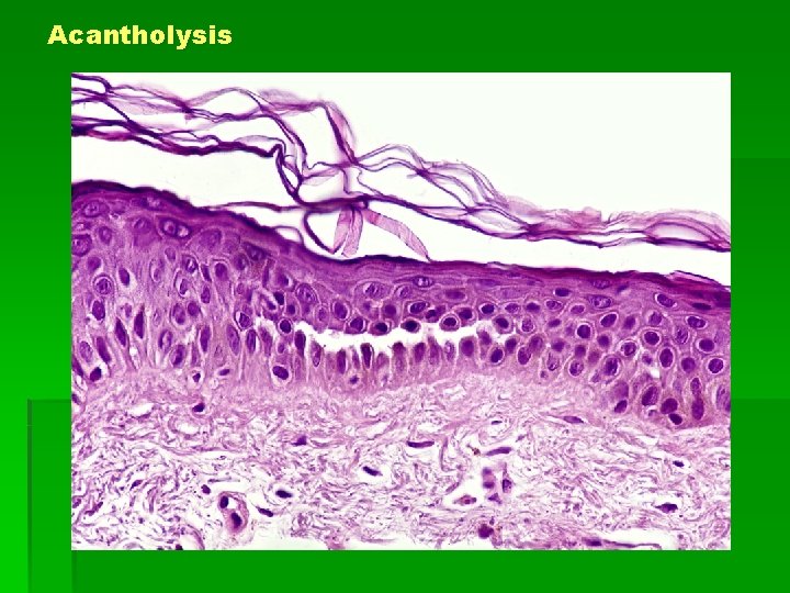 Acantholysis 