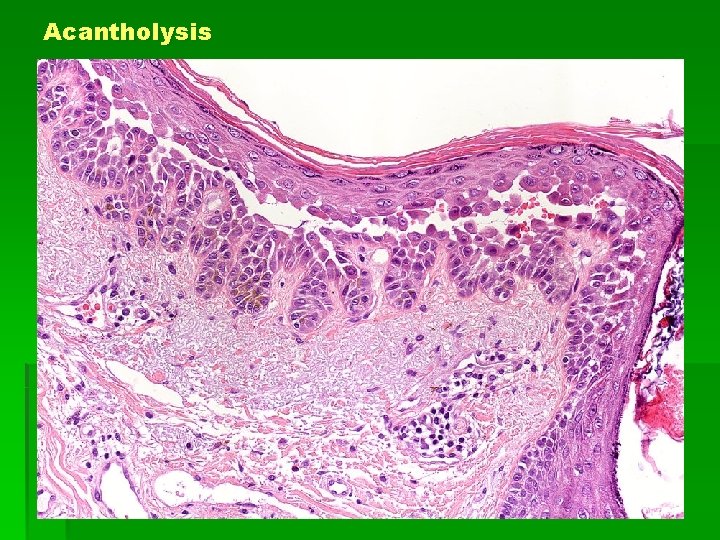 Acantholysis 