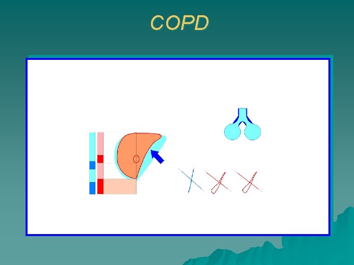 COPD 
