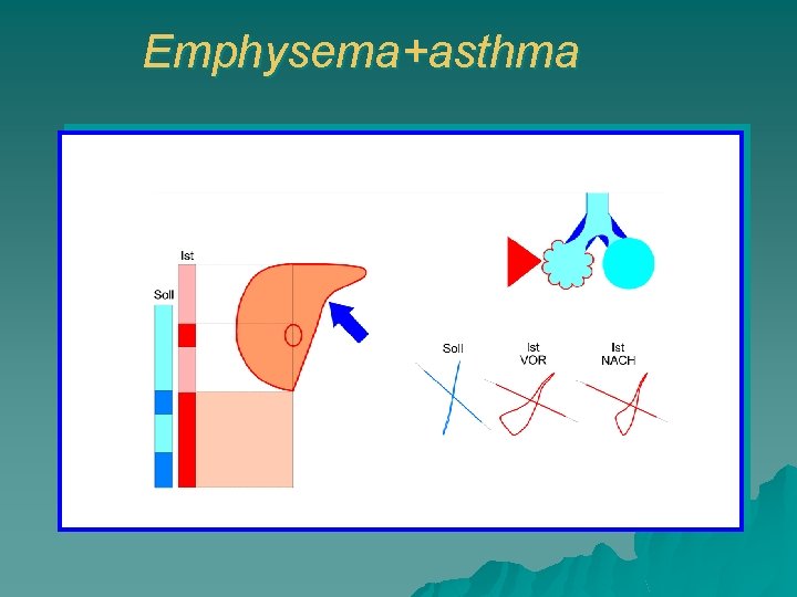 Emphysema+asthma 