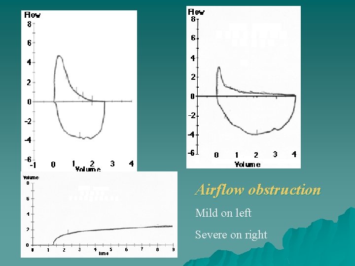 Airflow obstruction Mild on left Severe on right 