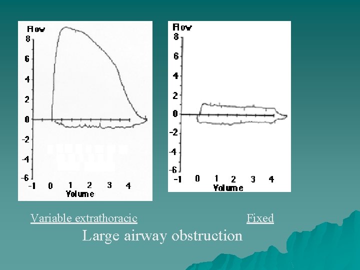 Variable extrathoracic Large airway obstruction Fixed 