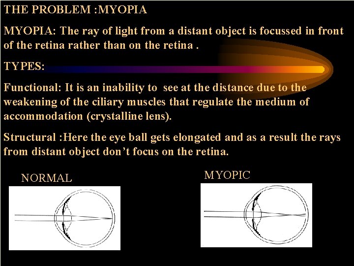 THE PROBLEM : MYOPIA: The ray of light from a distant object is focussed