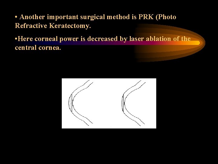  • Another important surgical method is PRK (Photo Refractive Keratectomy. • Here corneal