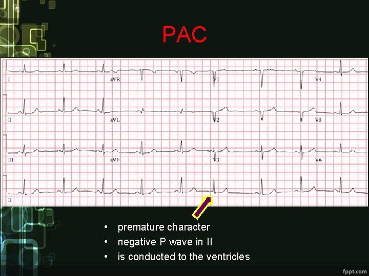 PAC • premature character • negative P wave in II • is conducted to PAC • premature character • negative P wave in II • is conducted to