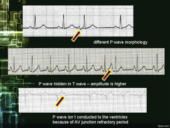 different P wave morphology P wave hidden in T wave – amplitude is higher different P wave morphology P wave hidden in T wave – amplitude is higher