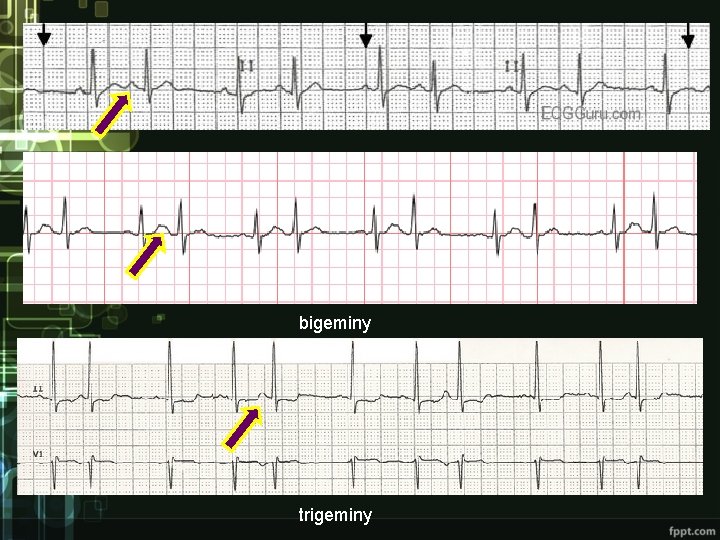 bigeminy trigeminy bigeminy trigeminy