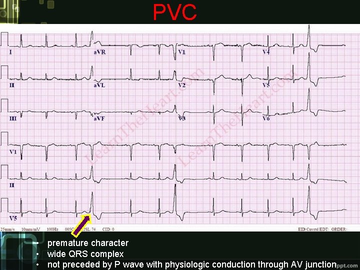 PVC • premature character • wide QRS complex • not preceded by P wave PVC • premature character • wide QRS complex • not preceded by P wave