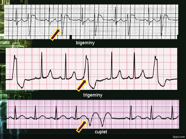 bigeminy trigeminy cuplet bigeminy trigeminy cuplet