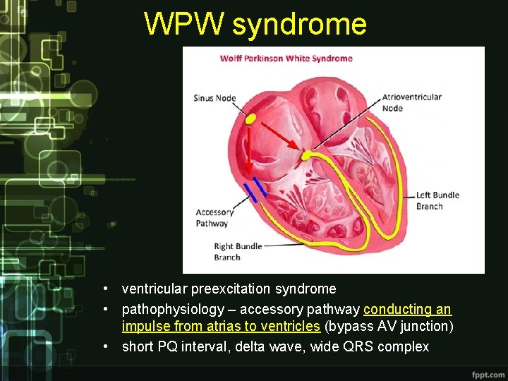 WPW syndrome • ventricular preexcitation syndrome • pathophysiology – accessory pathway conducting an impulse WPW syndrome • ventricular preexcitation syndrome • pathophysiology – accessory pathway conducting an impulse