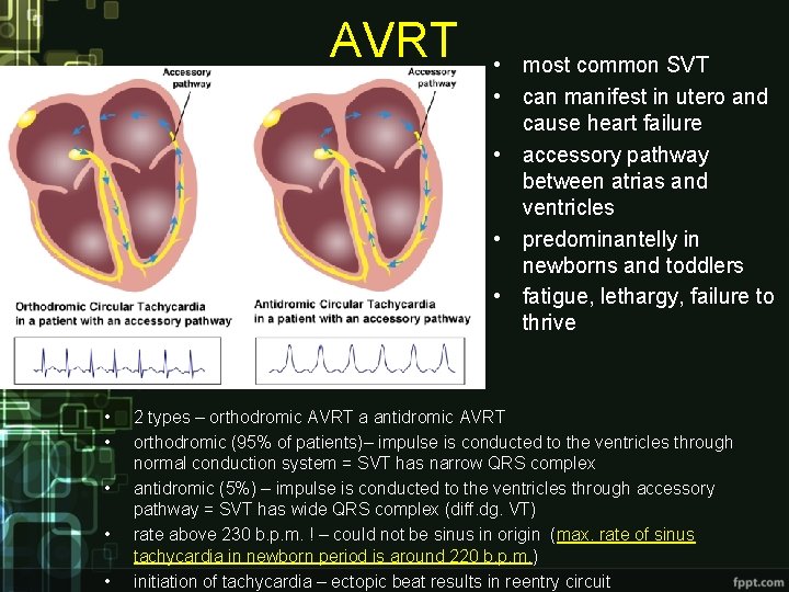 AVRT • • • most common SVT • can manifest in utero and cause AVRT • • • most common SVT • can manifest in utero and cause