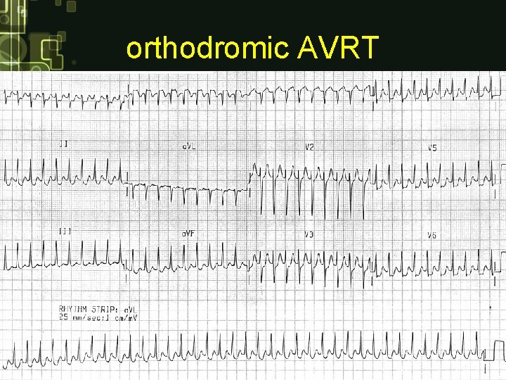 orthodromic AVRT orthodromic AVRT