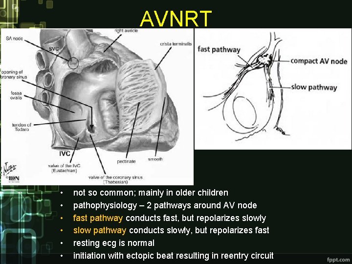 AVNRT • • • not so common; mainly in older children pathophysiology – 2 AVNRT • • • not so common; mainly in older children pathophysiology – 2