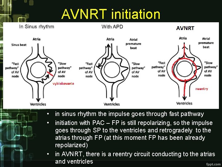 AVNRT initiation • in sinus rhythm the impulse goes through fast pathway • initiation AVNRT initiation • in sinus rhythm the impulse goes through fast pathway • initiation