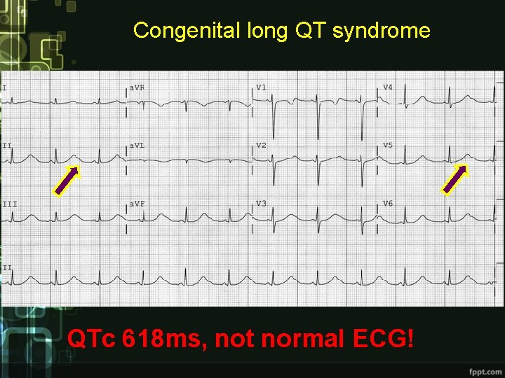 Congenital long QT syndrome QTc 618 ms, not normal ECG! Congenital long QT syndrome QTc 618 ms, not normal ECG!