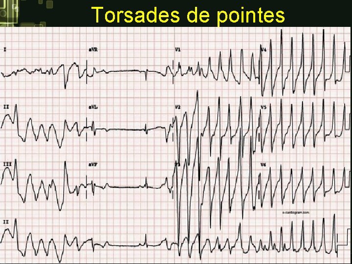 Torsades de pointes Torsades de pointes