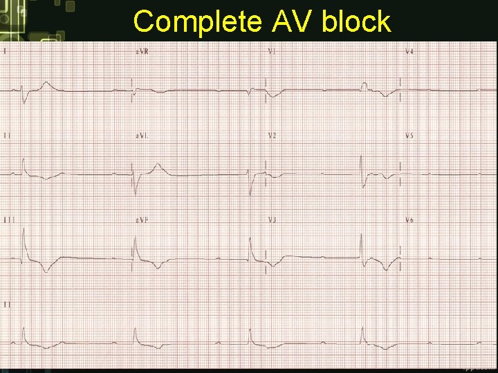 Complete AV block Complete AV block