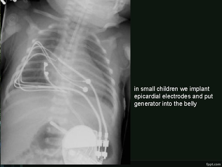 in small children we implant epicardial electrodes and put generator into the belly in small children we implant epicardial electrodes and put generator into the belly