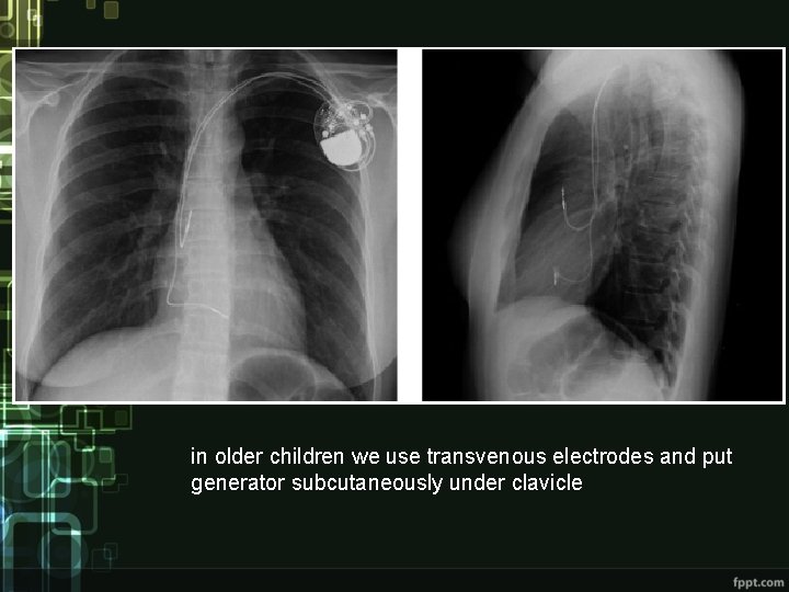 in older children we use transvenous electrodes and put generator subcutaneously under clavicle in older children we use transvenous electrodes and put generator subcutaneously under clavicle