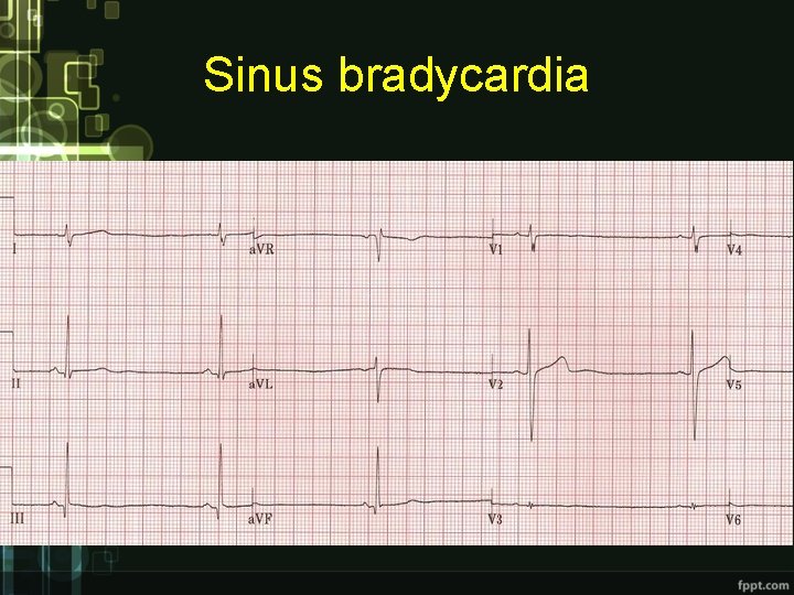 Sinus bradycardia Sinus bradycardia