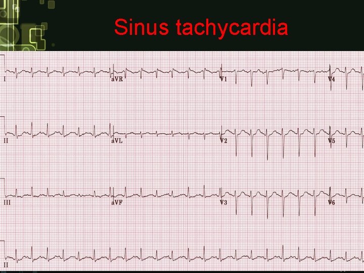 Sinus tachycardia Sinus tachycardia