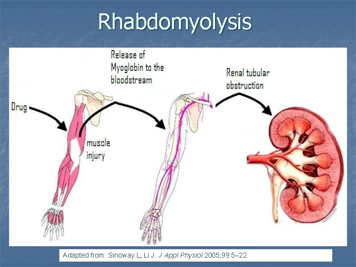 Rhabdomyolysis Adapted from: Sinoway L, Li J. J Appl Physiol 2005; 99: 5– 22.