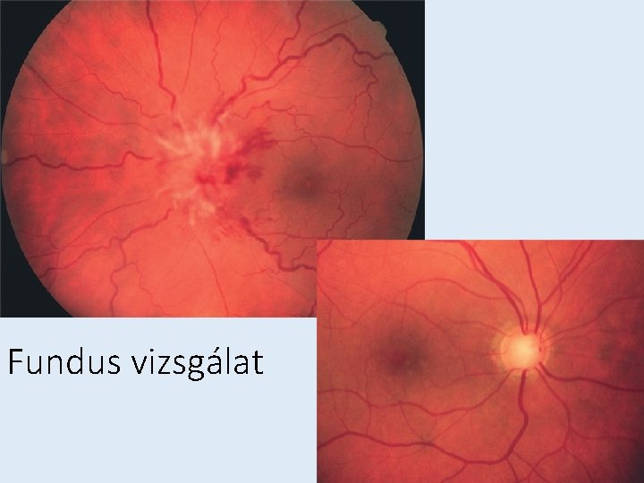 Fundus vizsgálat 