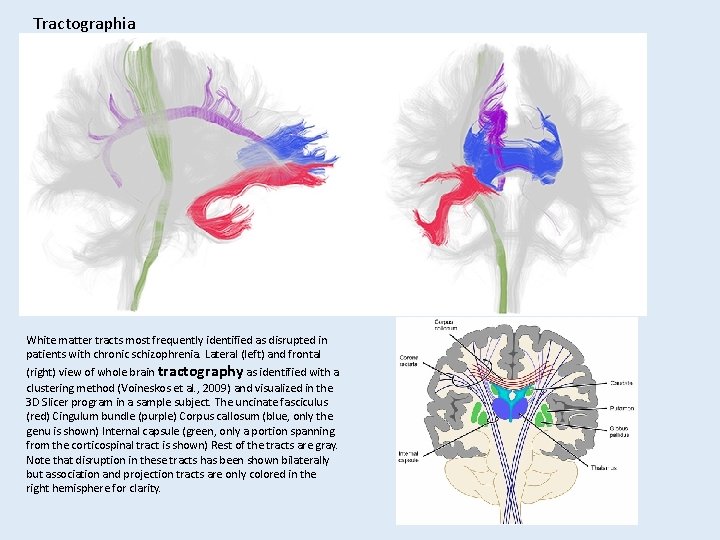 Tractographia White matter tracts most frequently identified as disrupted in patients with chronic schizophrenia.