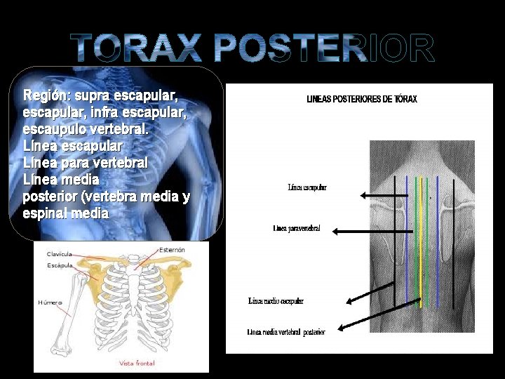 Región: supra escapular, infra escapular, escaupulo vertebral. Línea escapular Línea para vertebral Línea media Región: supra escapular, infra escapular, escaupulo vertebral. Línea escapular Línea para vertebral Línea media