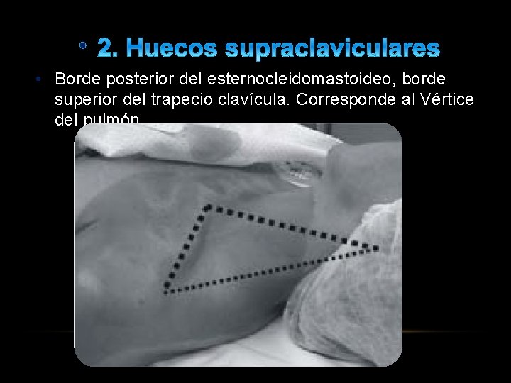  • • Borde posterior del esternocleidomastoideo, borde superior del trapecio clavícula. Corresponde al