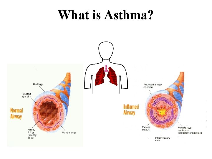 What is Asthma? 