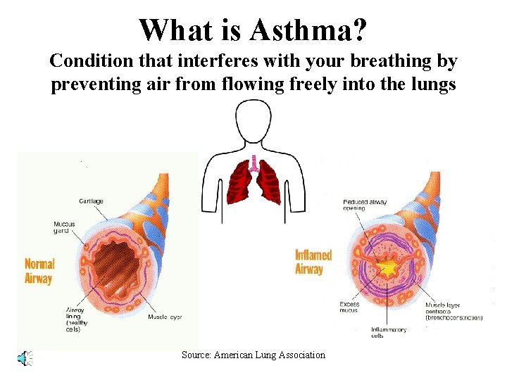 What is Asthma? Condition that interferes with your breathing by preventing air from flowing