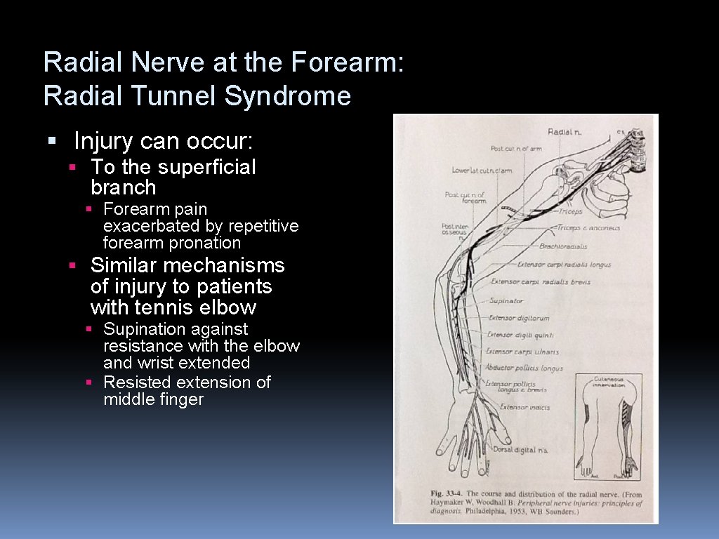 Radial Nerve at the Forearm: Radial Tunnel Syndrome § Injury can occur: § To