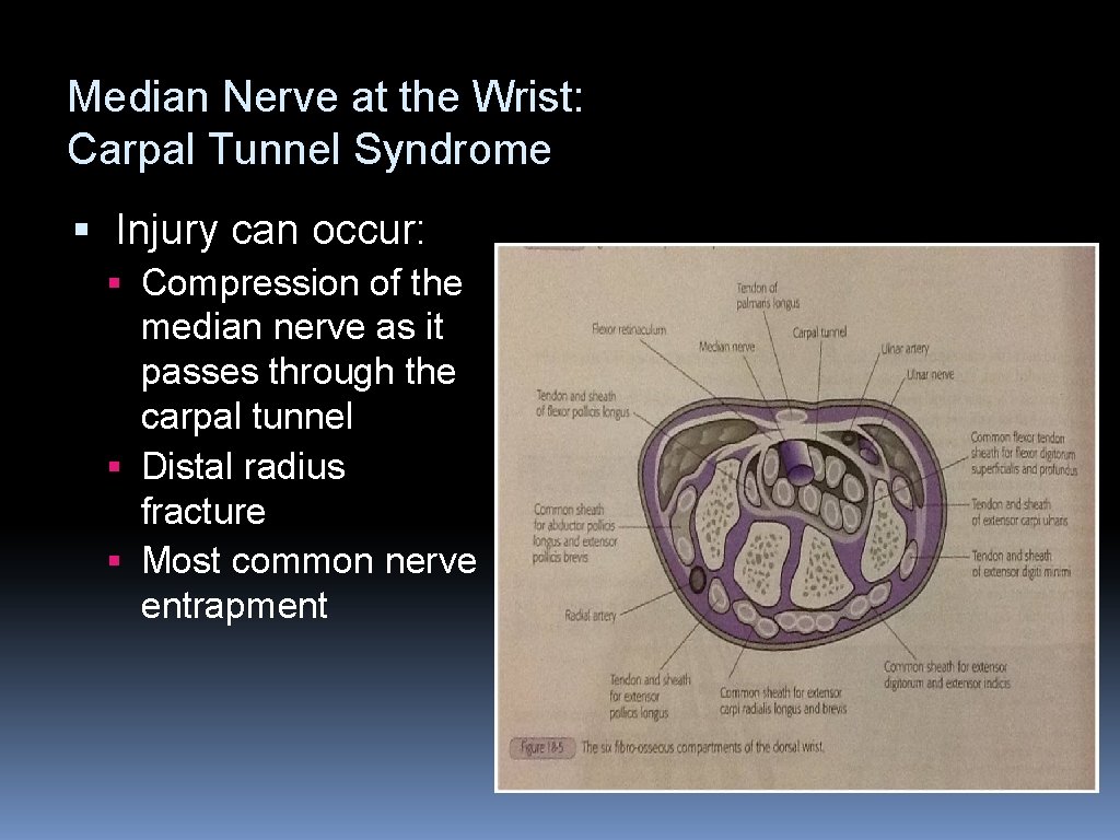 Median Nerve at the Wrist: Carpal Tunnel Syndrome § Injury can occur: § Compression