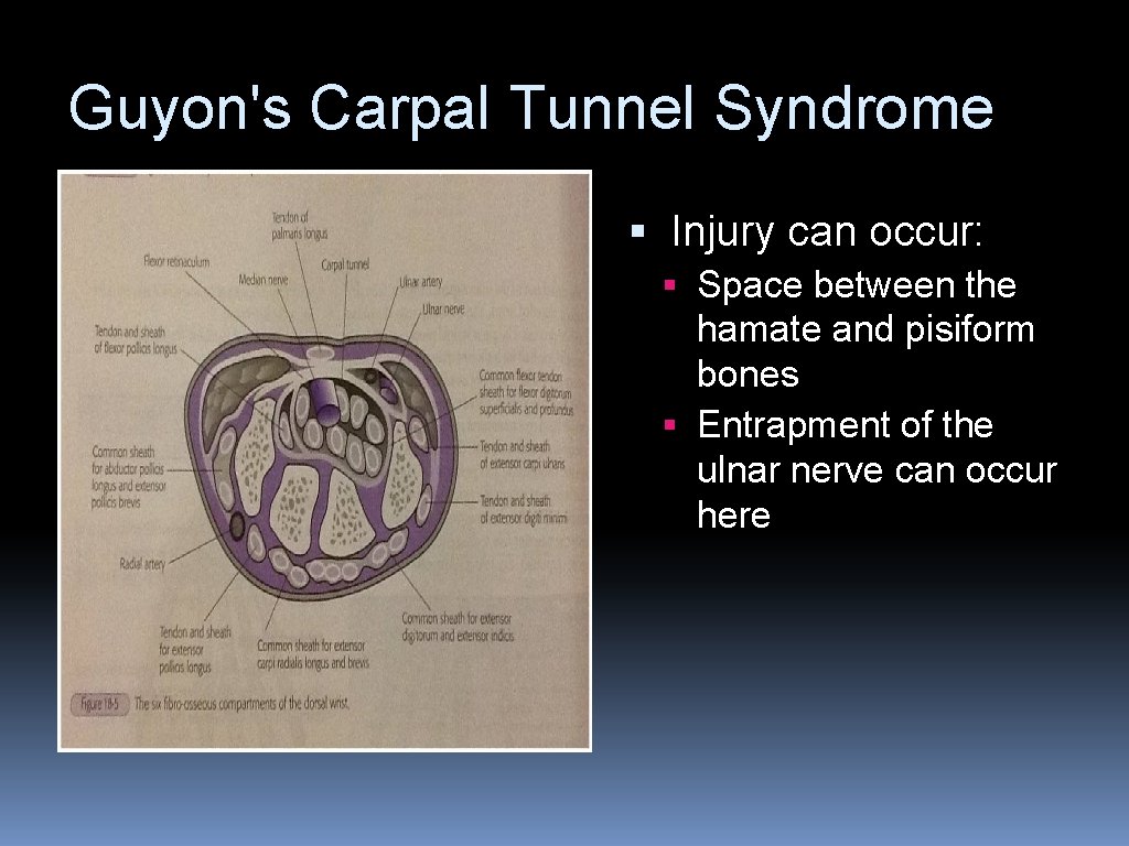 Guyon's Carpal Tunnel Syndrome § Injury can occur: § Space between the hamate and