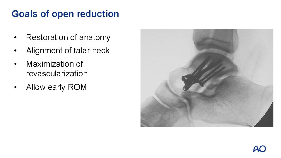 Goals of open reduction • Restoration of anatomy • Alignment of talar neck •