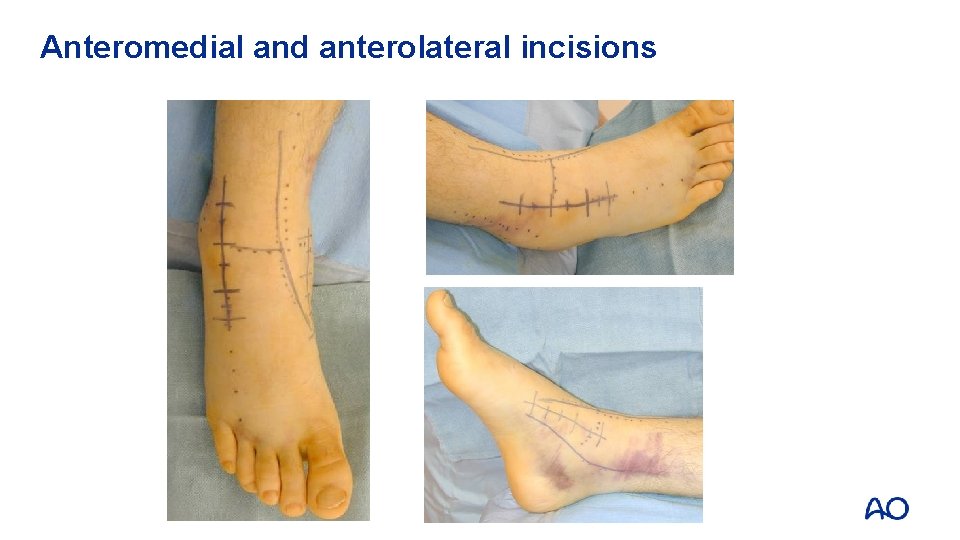 Anteromedial and anterolateral incisions 