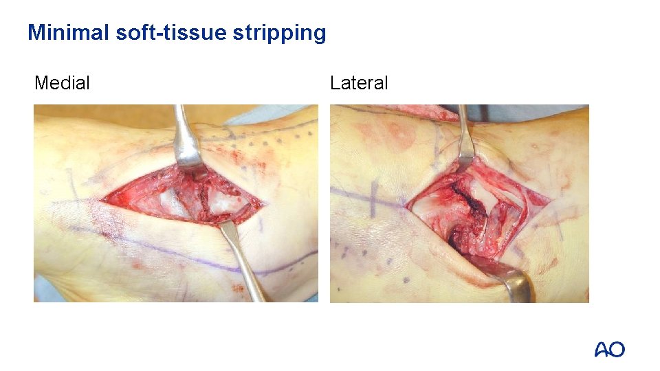 Minimal soft-tissue stripping Medial Lateral 