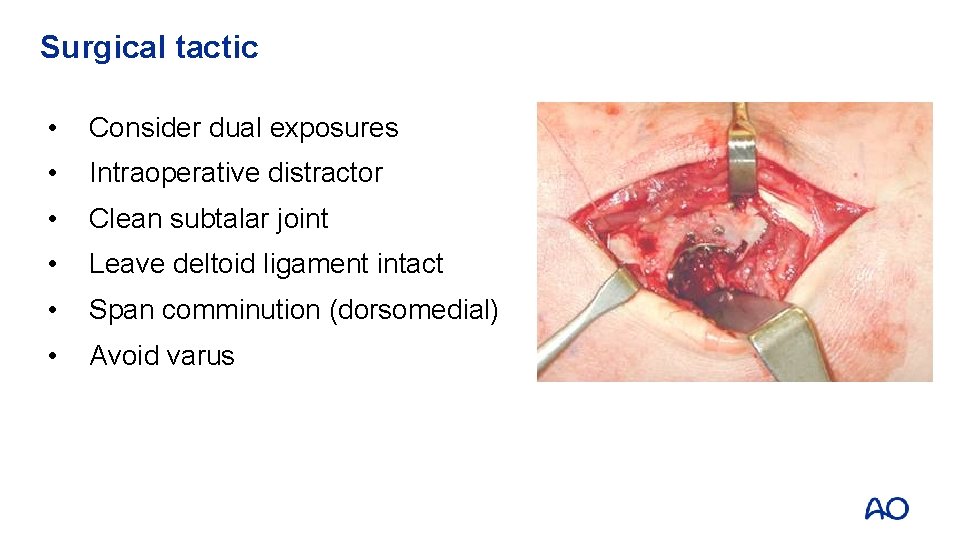Surgical tactic • Consider dual exposures • Intraoperative distractor • Clean subtalar joint •