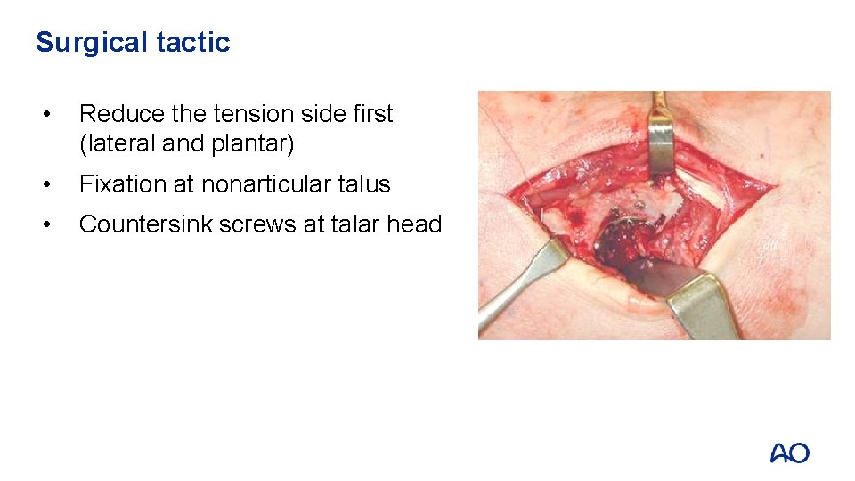 Surgical tactic • Reduce the tension side first (lateral and plantar) • Fixation at