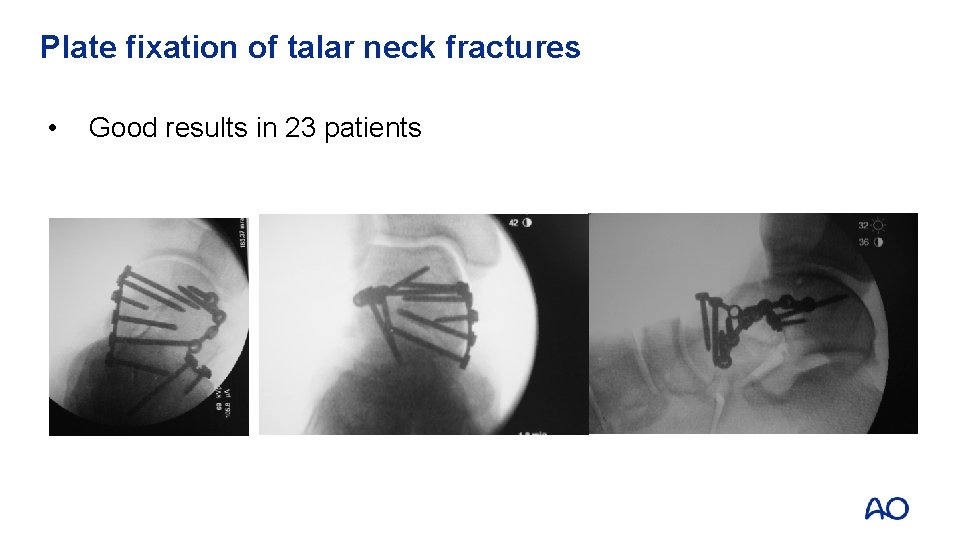 Plate fixation of talar neck fractures • Good results in 23 patients 