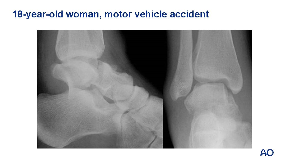 18 -year-old woman, motor vehicle accident 