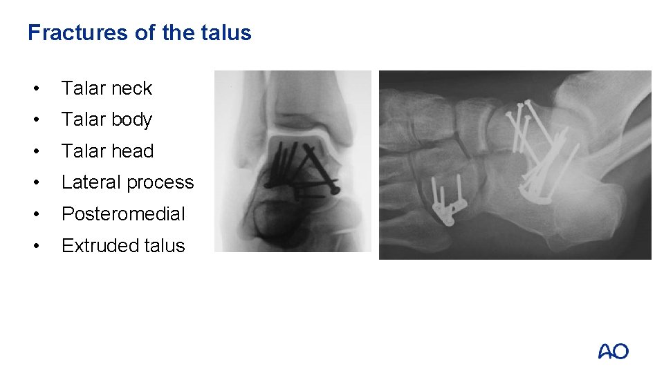 Fractures of the talus • Talar neck • Talar body • Talar head •