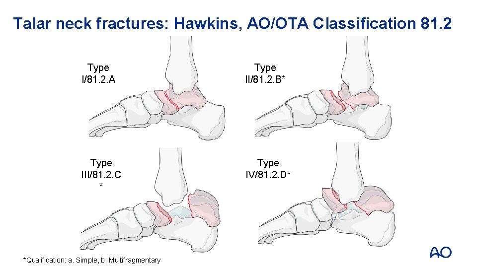 Talar neck fractures: Hawkins, AO/OTA Classification 81. 2 Type I/81. 2. A Type II/81.