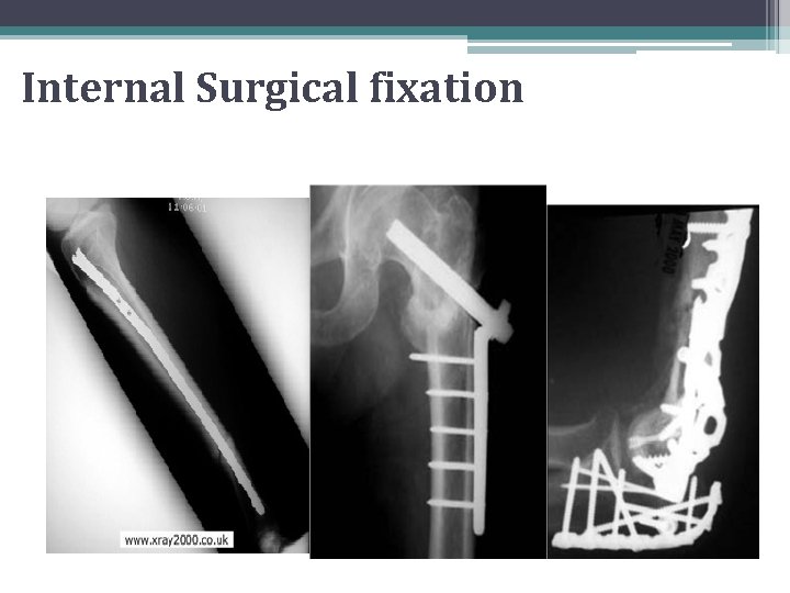 Internal Surgical fixation 