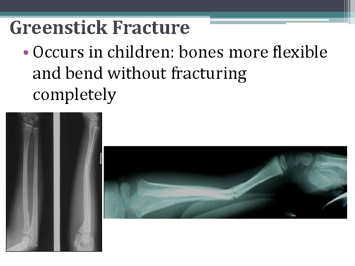 Greenstick Fracture • Occurs in children: bones more flexible and bend without fracturing completely