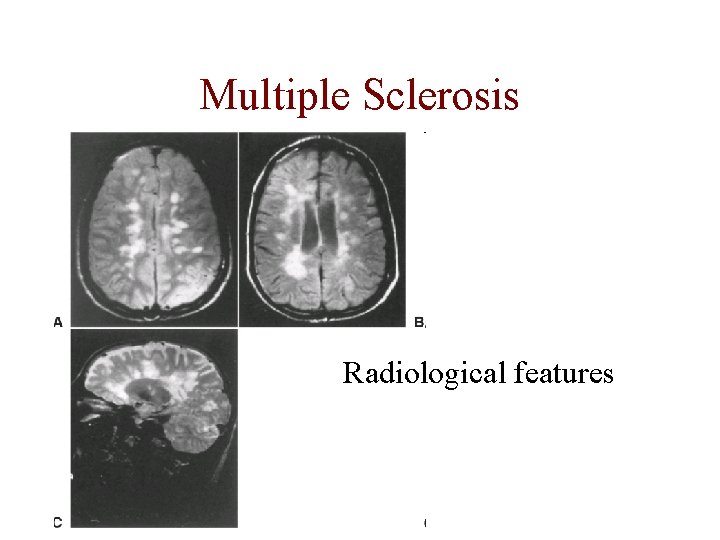 Multiple Sclerosis Radiological features 
