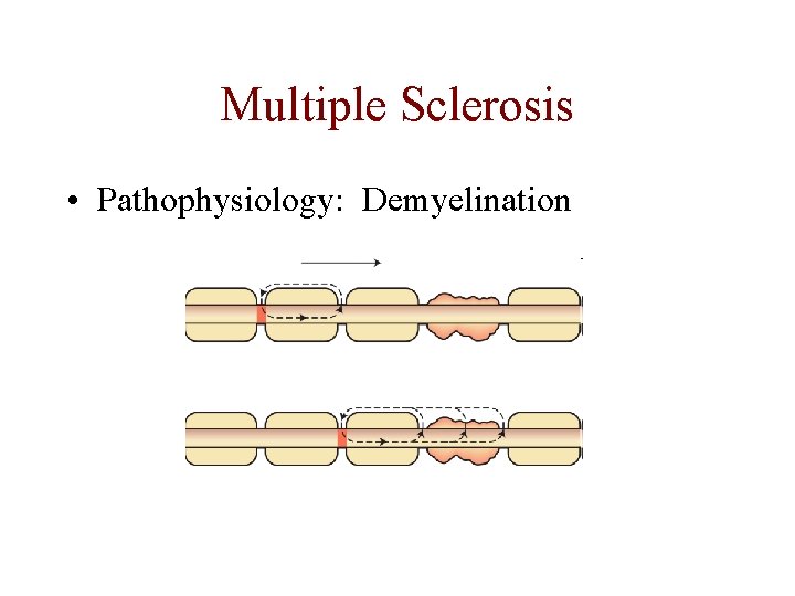 Multiple Sclerosis • Pathophysiology: Demyelination 