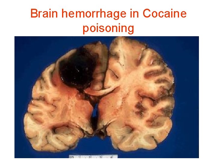Brain hemorrhage in Cocaine poisoning 